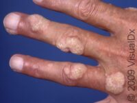 Common Wart