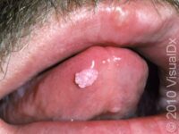 Genital Wart (Condyloma Acuminatum)