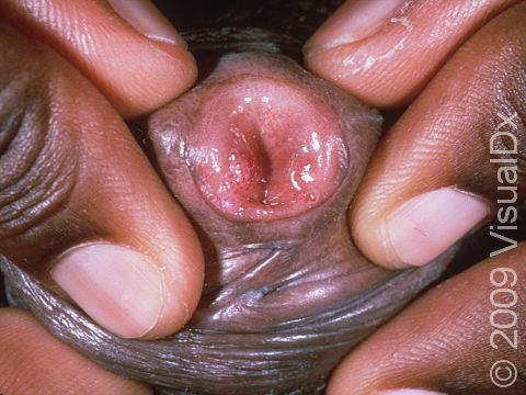 Genital warts (condyloma) can circle the opening of the penis.