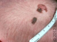 Birthmark (Congenital Melanocytic Nevus)