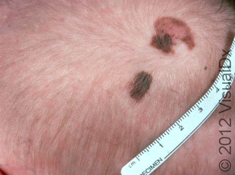 Moles (nevi) present at birth, made up of nests of pigment-producing cells, are known as congenital melanocytic nevi.