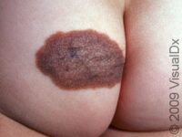 Birthmark (Congenital Melanocytic Nevus)