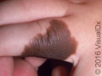 Birthmark (Congenital Melanocytic Nevus)
