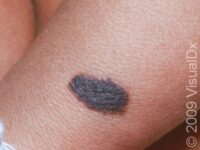 Birthmark (Congenital Melanocytic Nevus)