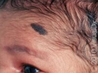 Birthmark (Congenital Melanocytic Nevus)