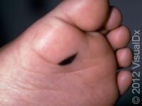 Birthmark (Congenital Melanocytic Nevus)