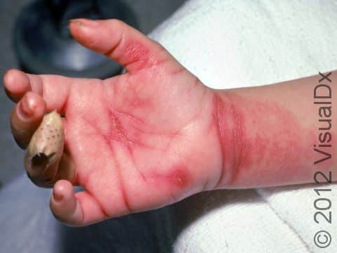 Allergic contact dermatitis is marked by redness, swelling, and itching. This child is allergic to the nickel content of the watch he had been wearing.