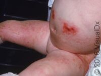 Allergic Contact Dermatitis (Pediatric)