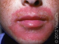 Allergic Contact Dermatitis (Pediatric)