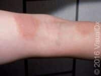 Allergic Contact Dermatitis (Pediatric)