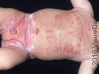 Allergic Contact Dermatitis (Pediatric)