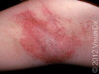 Allergic Contact Dermatitis