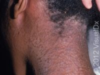 Allergic Contact Dermatitis