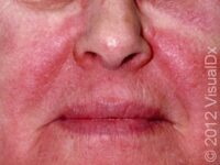 Allergic Contact Dermatitis