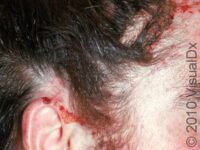 Allergic Contact Dermatitis
