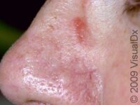 Allergic Contact Dermatitis