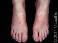 Allergic Contact Dermatitis