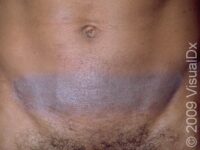 Allergic Contact Dermatitis