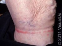 Allergic Contact Dermatitis