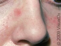 Allergic Contact Dermatitis