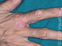 Allergic Contact Dermatitis
