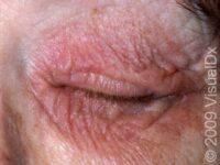 Allergic Contact Dermatitis