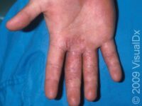 Allergic Contact Dermatitis