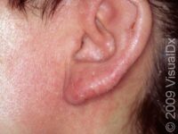 Allergic Contact Dermatitis