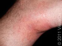 Allergic Contact Dermatitis
