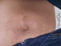 Allergic Contact Dermatitis