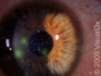 Corneal Abrasion – Adult