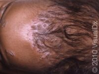 Cradle Cap