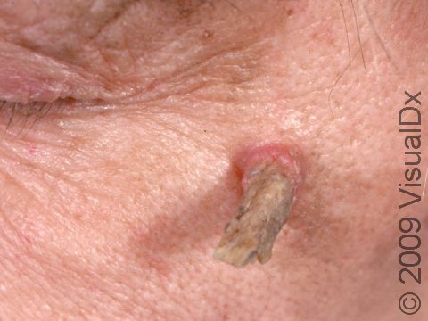 This image displays a cutaneous horn with a red, cancerous skin lesion at the base.