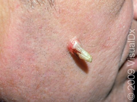 This image displays a cutaneous horn arising from a squamous cell carcinoma.