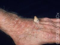 Cutaneous Horn