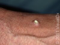 Cutaneous Horn