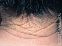 Cutis Rhomboidalis Nuchae