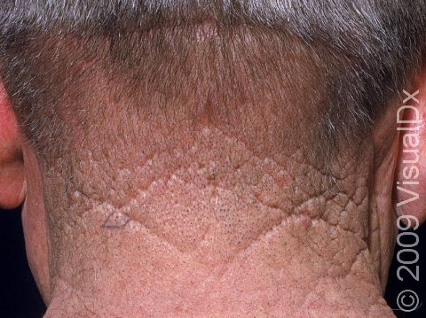 This image displays creases in the neck typical of chronic sun damage and aging.