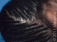 Dandruff