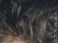 Dandruff