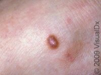 Dermatofibroma