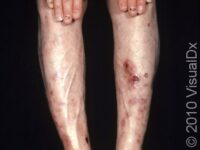 Diabetic Dermopathy
