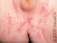 Diaper Dermatitis (Candidiasis)