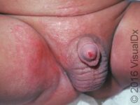 Diaper Rash (Irritant Diaper Dermatitis)