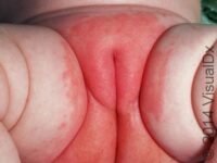 Diaper Rash (Irritant Diaper Dermatitis)