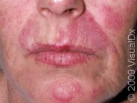 Discoid Lupus Erythematosus