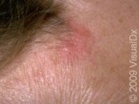 Discoid Lupus Erythematosus
