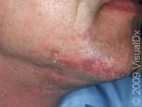 Discoid Lupus Erythematosus