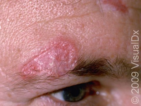 This image displays typical scarring due to discoid lupus erythematosus.