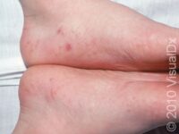 Dyshidrotic Eczema